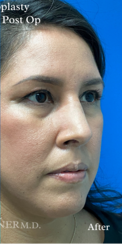 Rhinoplasty