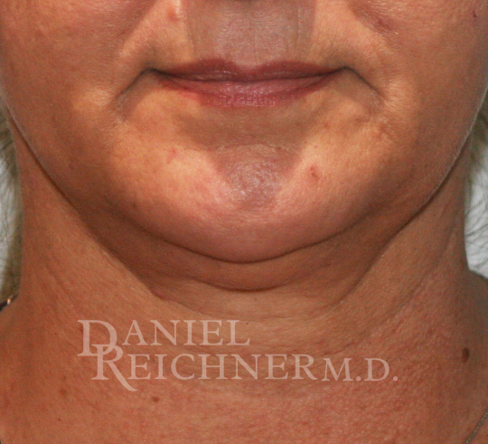 Face Liposuction